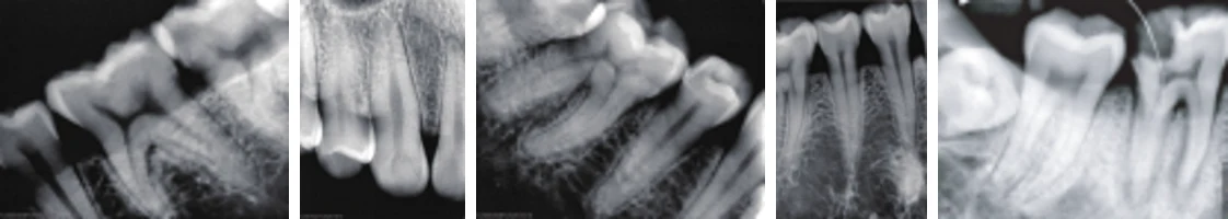 Sequência de radiografias periapicais em alta definição